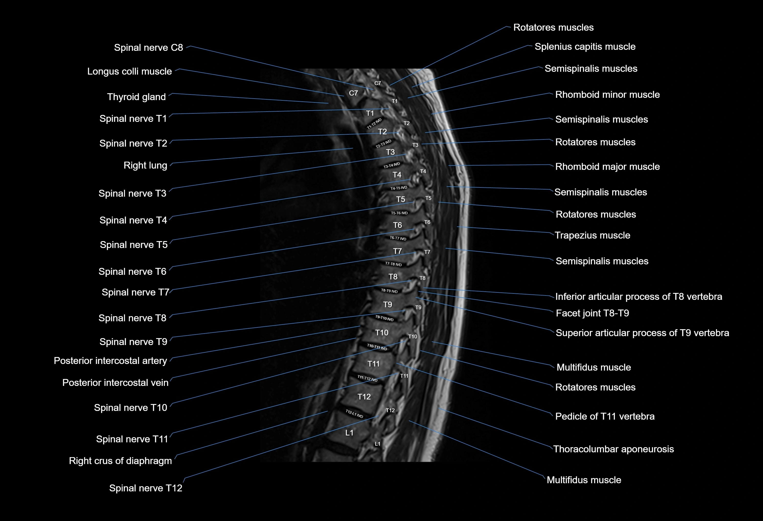 MRI thoracic spine sagittal  cross sectional anatomy 3T radiology  image-img-00001-00008.webp